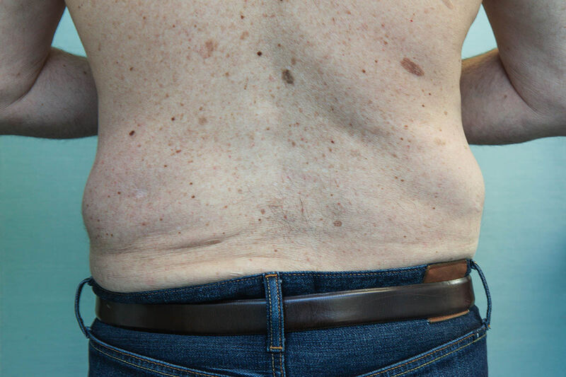 BodyTite Before & After Patient Photo