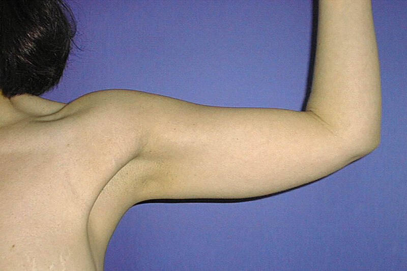 Liposuction Arms Before & After Patient Photo
