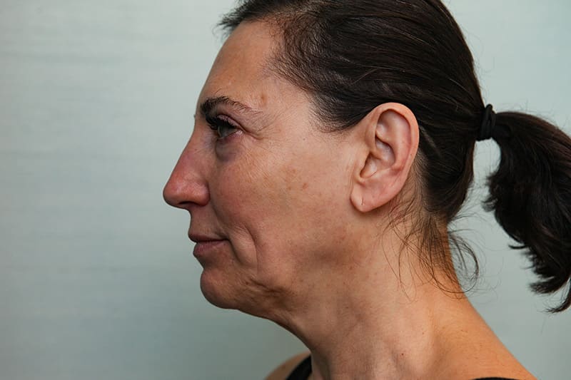 Facelift Before & After Patient Photo