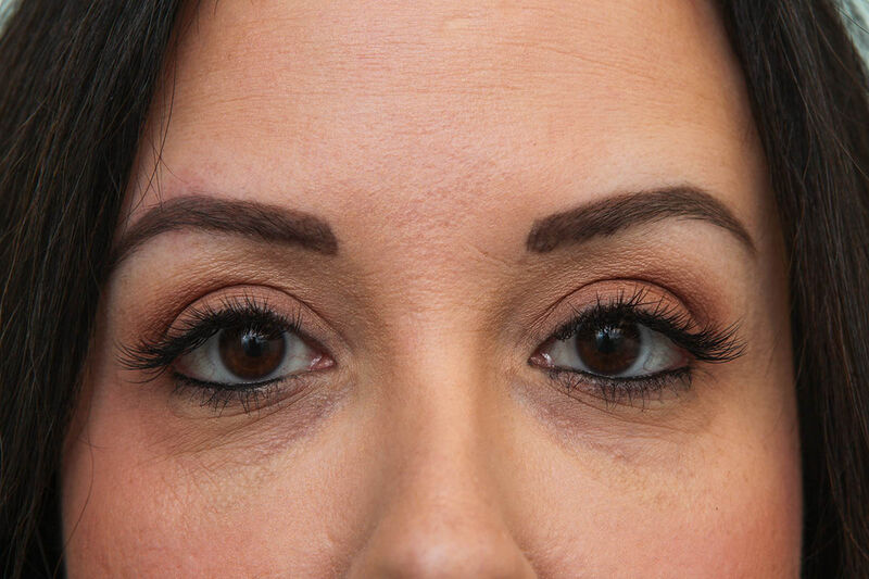 Upper Blepharoplasty Before & After Patient Photo