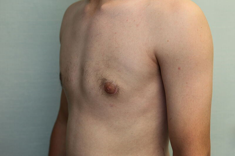 Gynecomastia Surgery Before & After Patient Photo