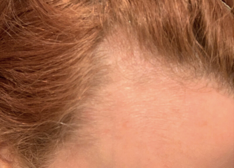 PRP Hair Restoration Before & After Patient Photo