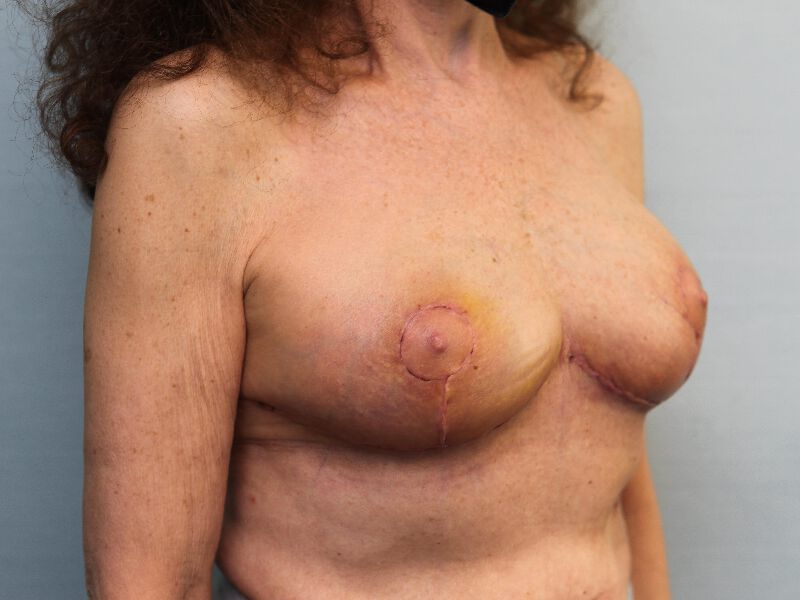 Westport breast reduction patient,right view after surgery