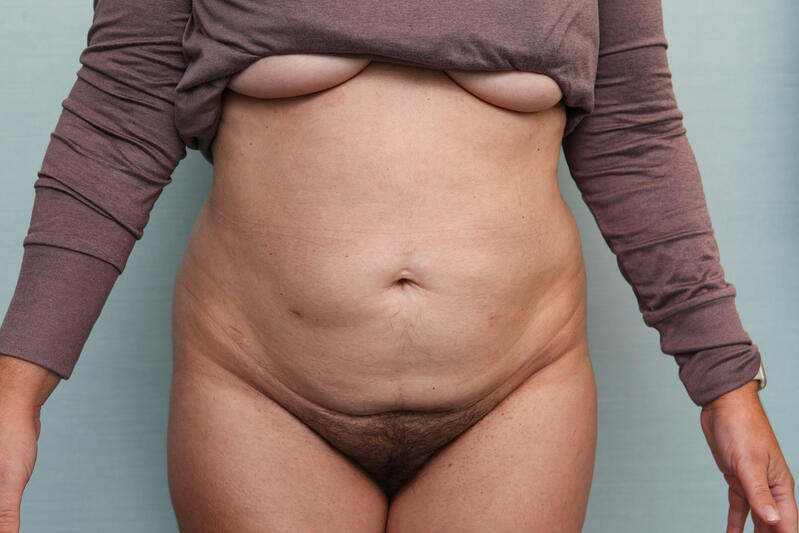 Abdominoplasty Before & After Patient Photo