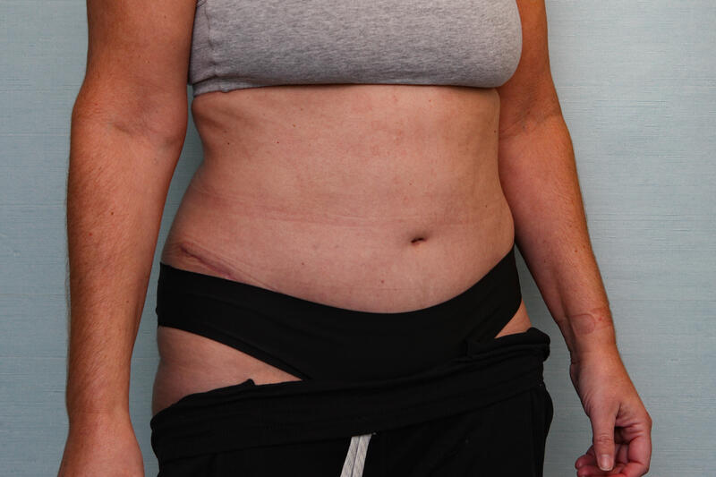 Abdominoplasty Before & After Patient Photo