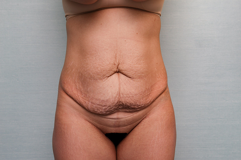 Abdominoplasty Before & After Patient Photo