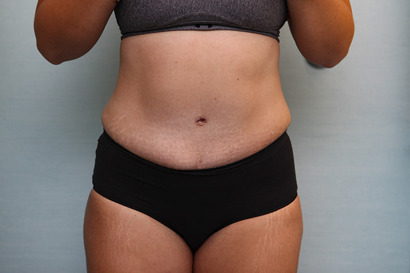 Abdominoplasty Before & After Patient Photo