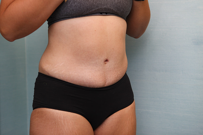 Abdominoplasty Before & After Patient Photo