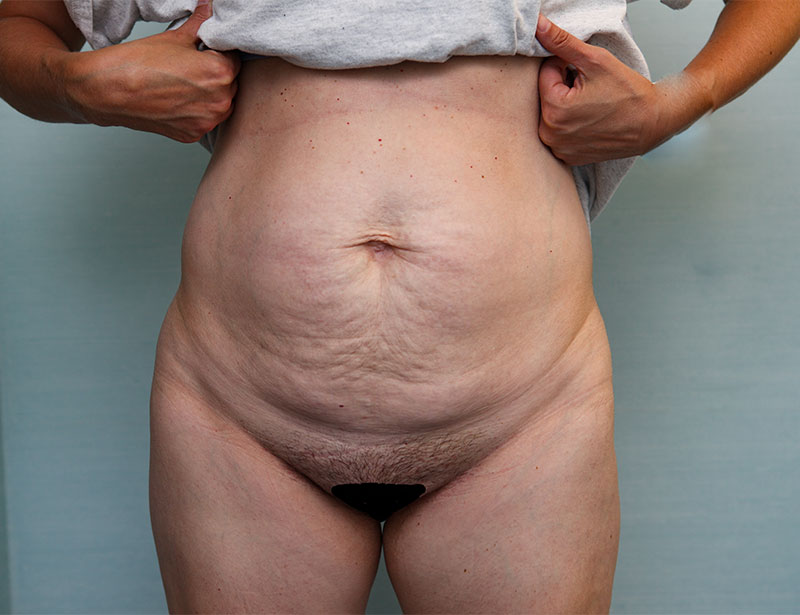 Abdominoplasty Before & After Patient Photo