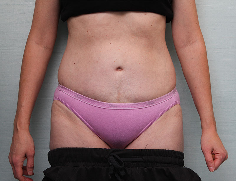 Abdominoplasty Before & After Patient Photo