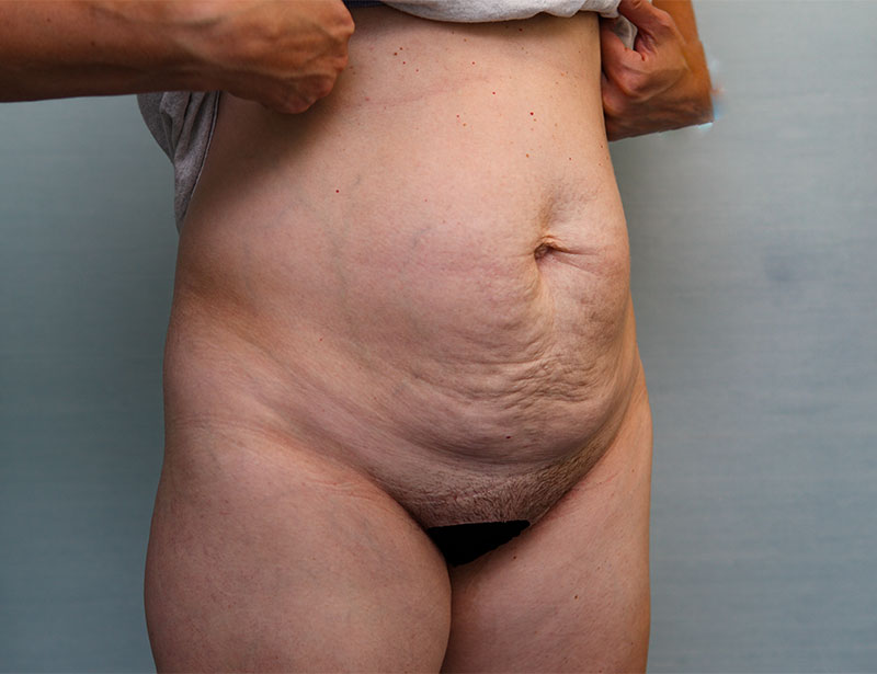 Abdominoplasty Before & After Patient Photo