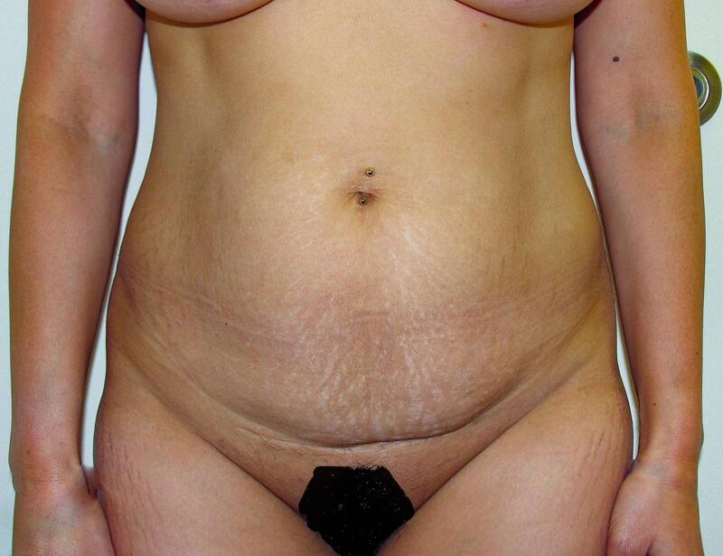 Abdominoplasty Before & After Patient Photo