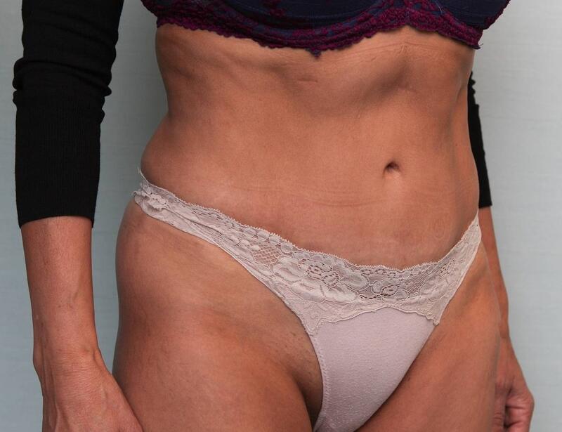 Abdominoplasty Before & After Patient Photo