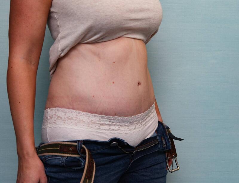 Abdominoplasty Before & After Patient Photo