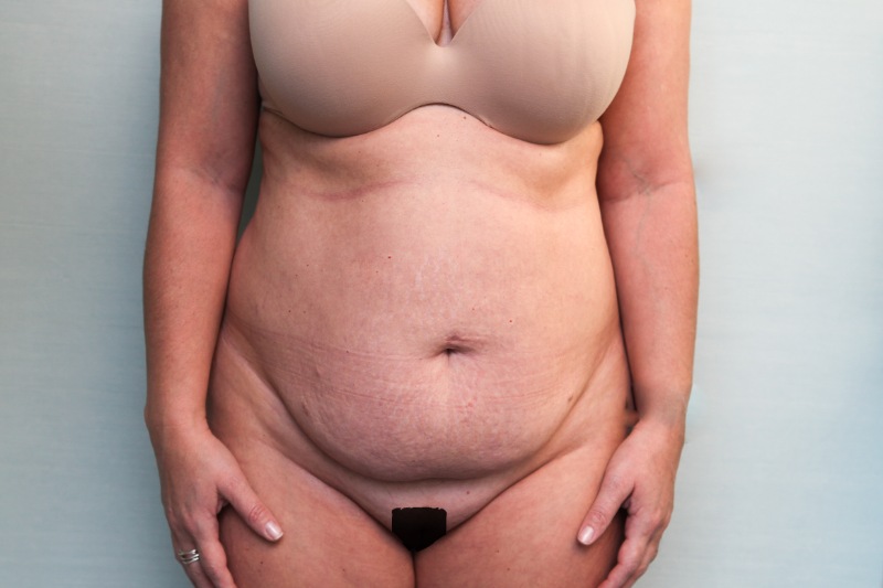 Abdominoplasty Before & After Patient Photo