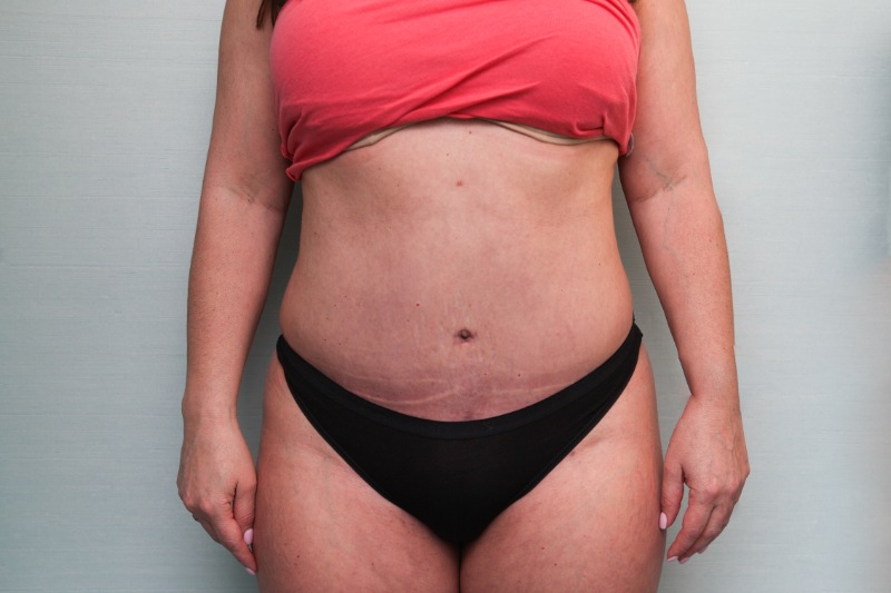 Abdominoplasty Before & After Patient Photo