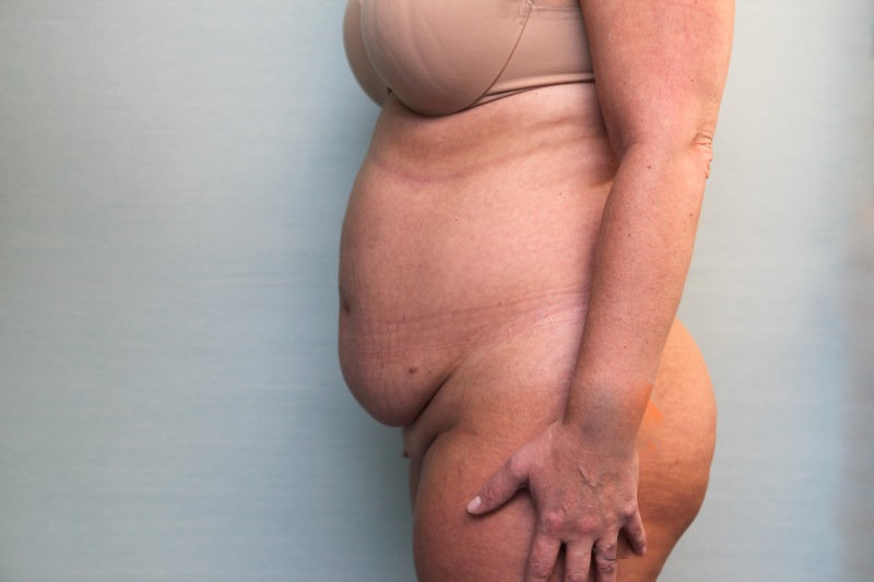 Abdominoplasty Before & After Patient Photo