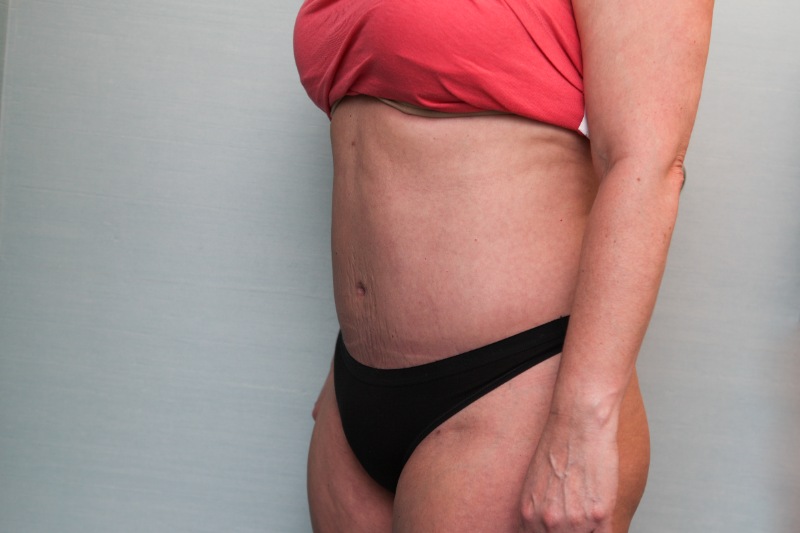 Abdominoplasty Before & After Patient Photo