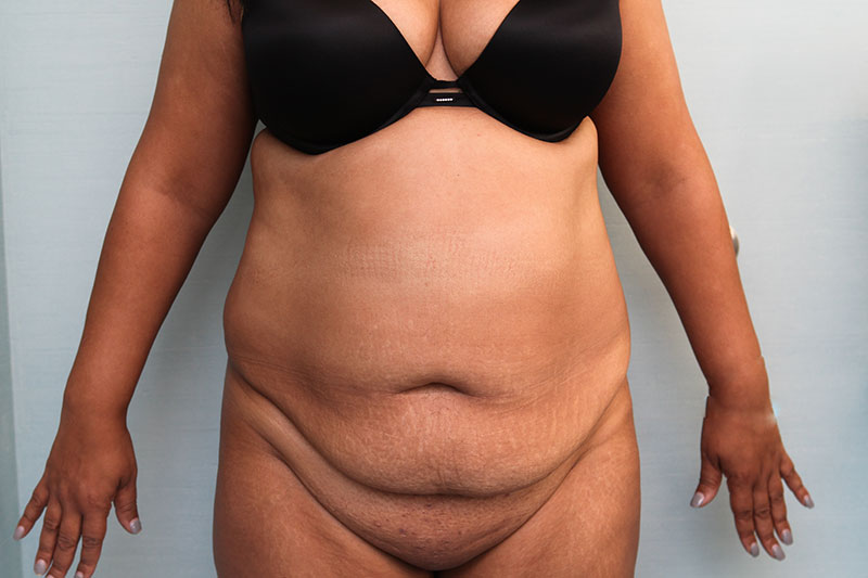 Abdominoplasty Before & After Patient Photo