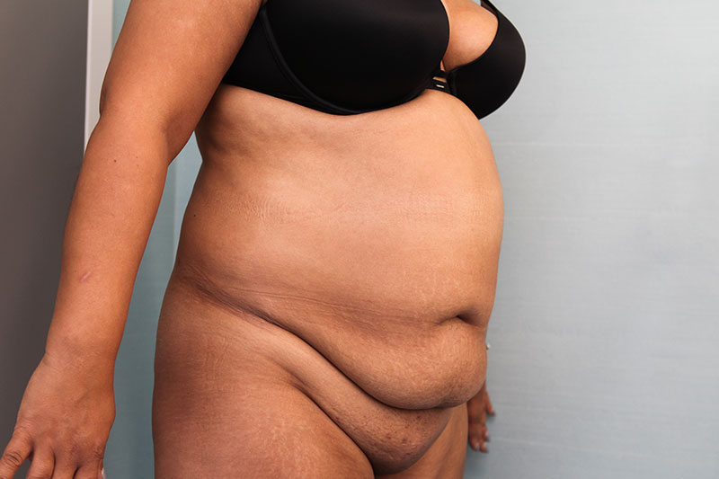 Abdominoplasty Before & After Patient Photo