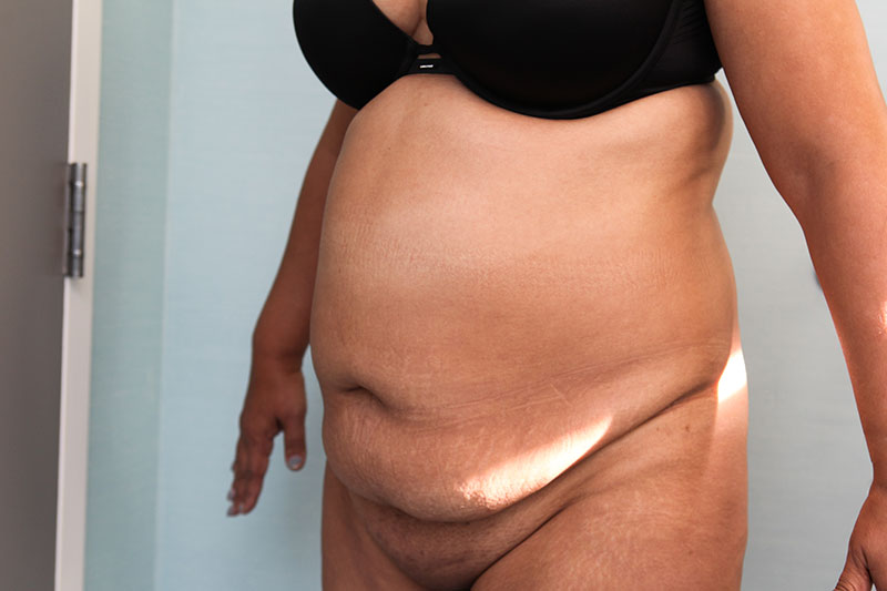 Abdominoplasty Before & After Patient Photo