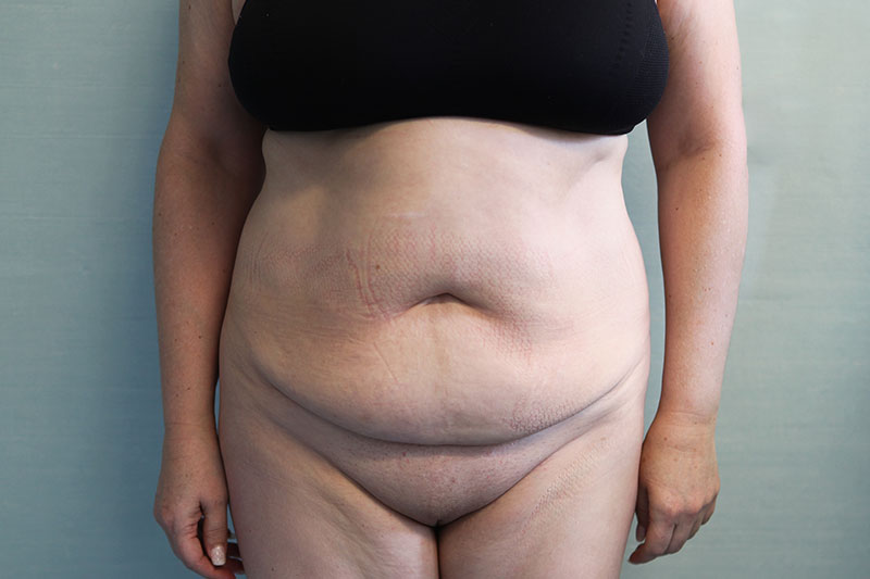 Abdominoplasty Before & After Patient Photo