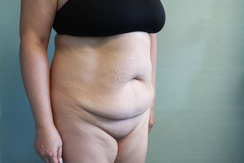 Abdominoplasty Before & After Patient Photo