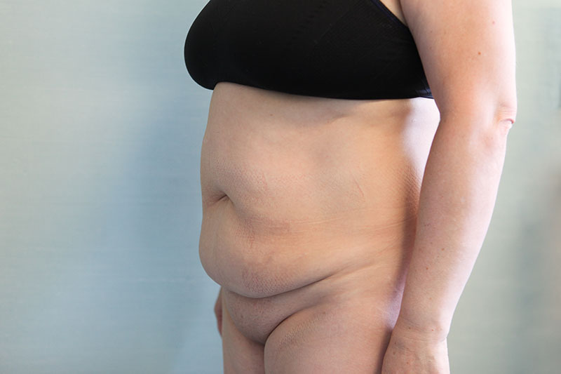 Abdominoplasty Before & After Patient Photo