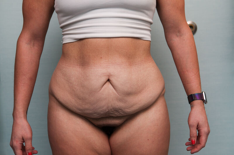 Abdominoplasty Before & After Patient Photo