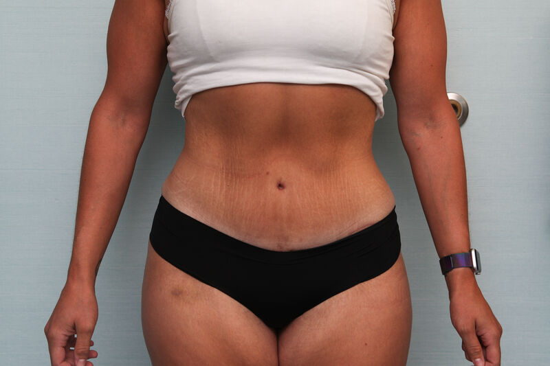 Abdominoplasty Before & After Patient Photo