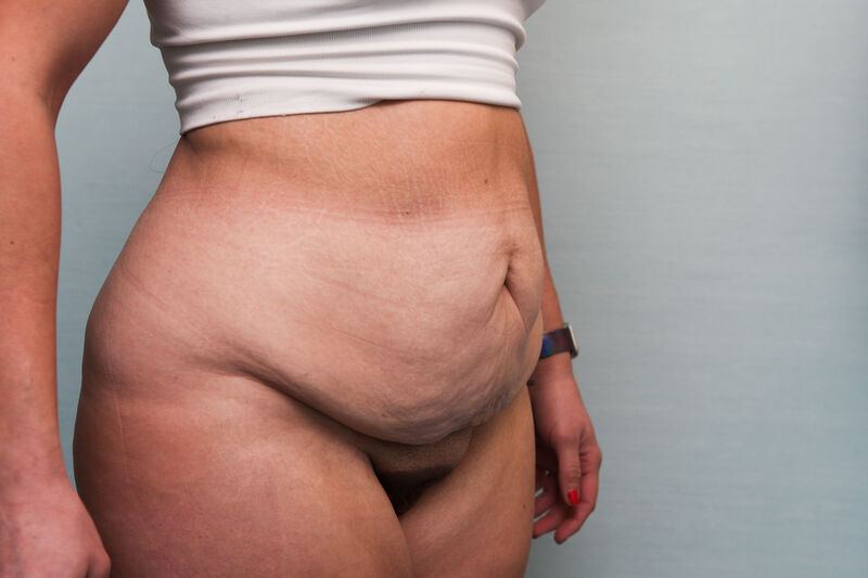 Abdominoplasty Before & After Patient Photo