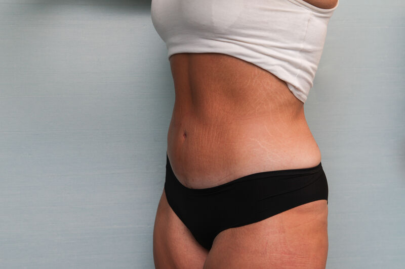 Abdominoplasty Before & After Patient Photo