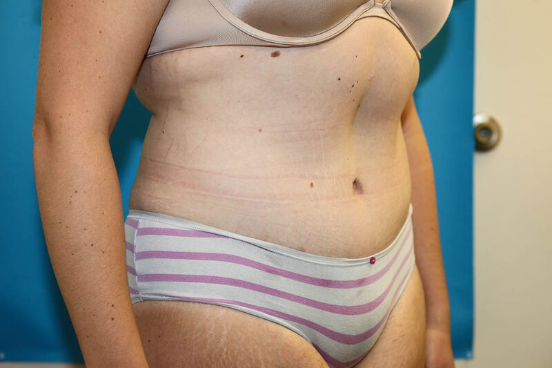 Abdominoplasty Before & After Patient Photo