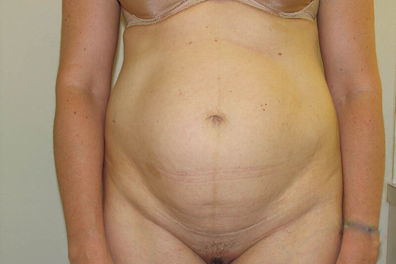 Abdominoplasty Before & After Patient Photo