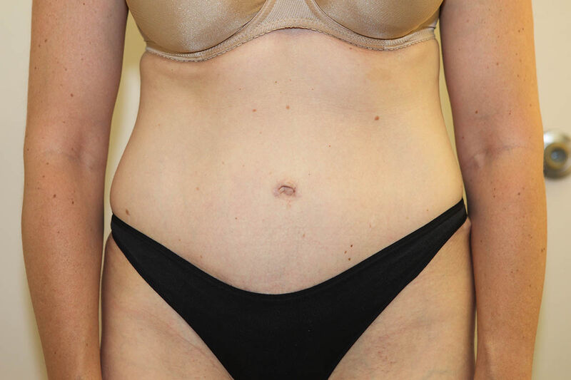 Abdominoplasty Before & After Patient Photo