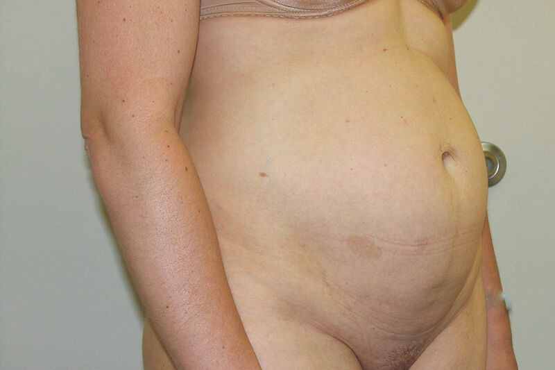 Abdominoplasty Before & After Patient Photo