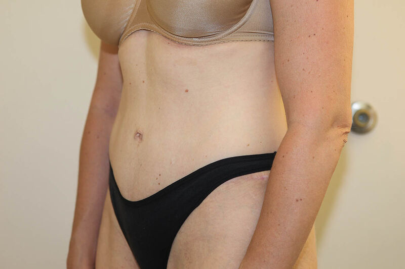 Abdominoplasty Before & After Patient Photo