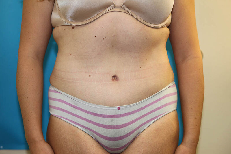 Abdominoplasty Before & After Patient Photo