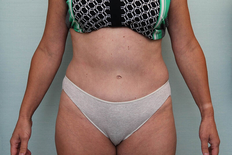 Abdominoplasty Before & After Patient Photo