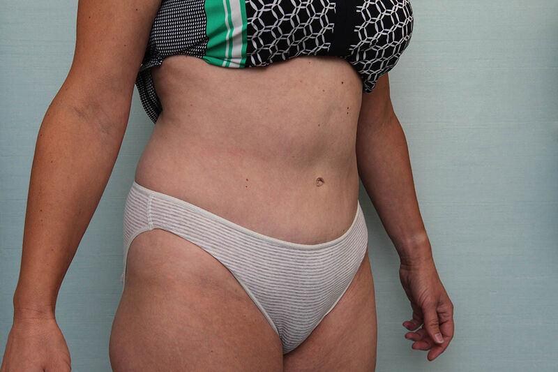 Abdominoplasty Before & After Patient Photo