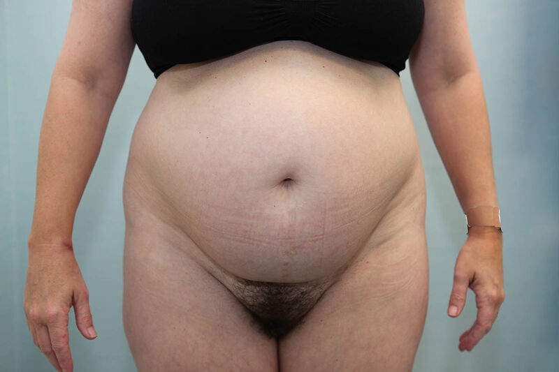 Abdominoplasty Before & After Patient Photo