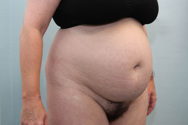 Abdominoplasty Before & After Patient Photo