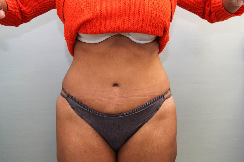 Abdominoplasty Before & After Patient Photo