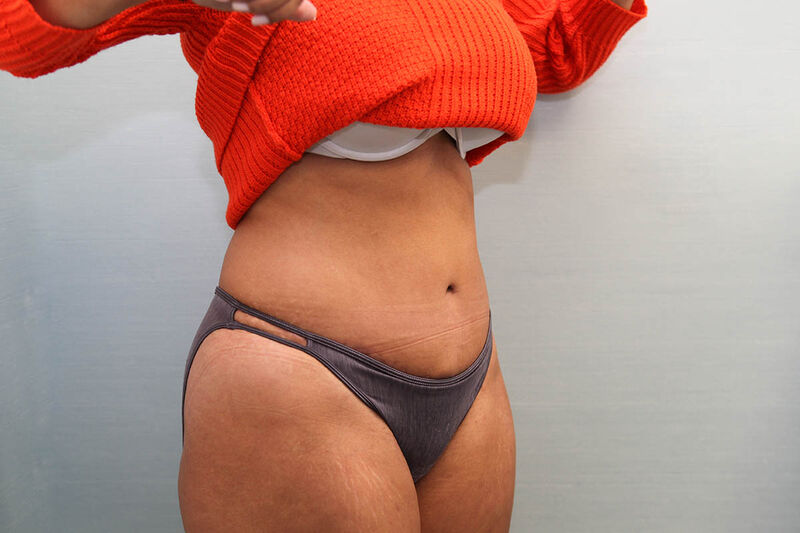 Abdominoplasty Before & After Patient Photo