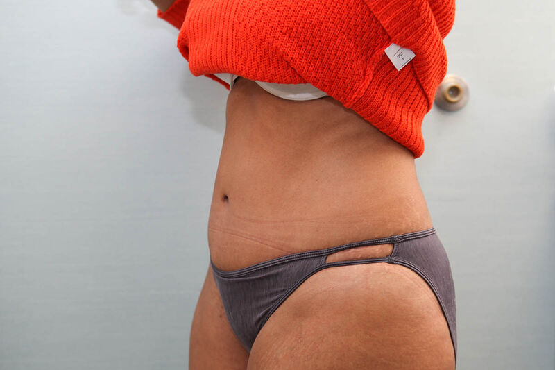 Abdominoplasty Before & After Patient Photo