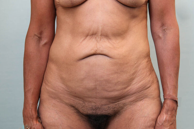 Abdominoplasty Before & After Patient Photo