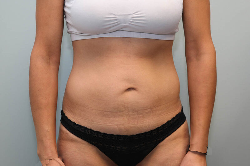 Abdominoplasty Before & After Patient Photo