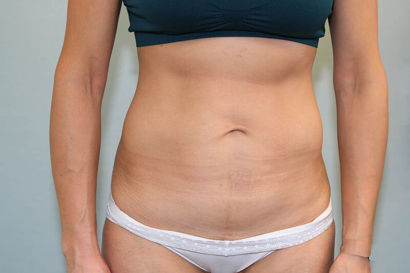 Abdominoplasty Before & After Patient Photo