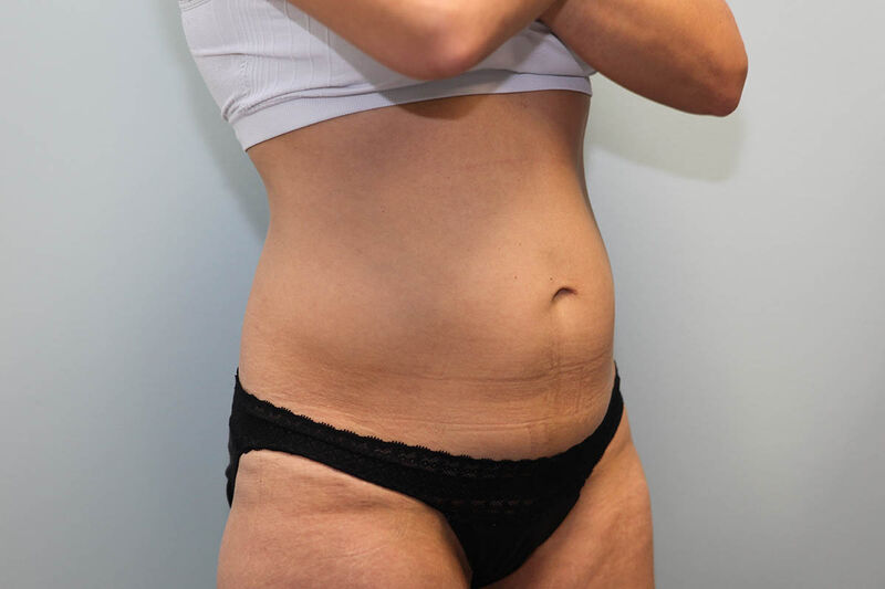 Abdominoplasty Before & After Patient Photo