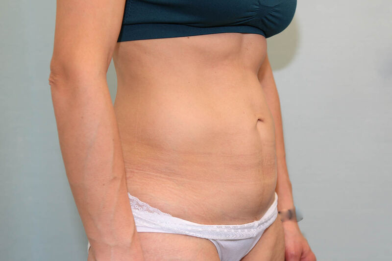 Abdominoplasty Before & After Patient Photo